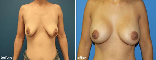 Breast Implants Before & After - Case II.