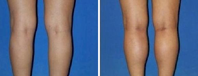 Calf Implants