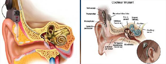 Cochlear Implants