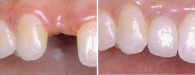 Dental Implants