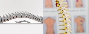 Spinal Implants