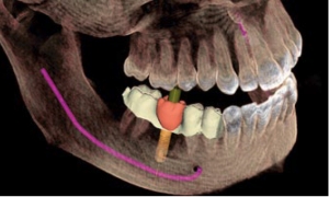 Dental Implant 3D