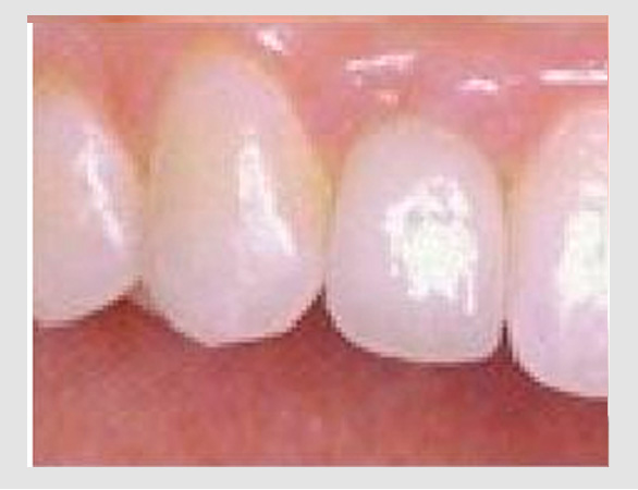 After-Dental Implant