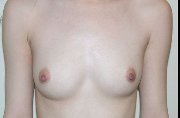 Before-21 year old female. Round Saline, 235cc in the right, 250cc in the left. Incision in armpit, Implant Pocket under breast and chest muscle.