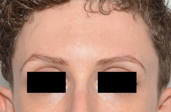 After-This female patient received 51 units of BOTOX for her forehead. Notice how smooth her forehead looks after the treatment.