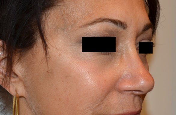 After-This female patient received 54 units of BOTOX to treat forehead lines and and crows feet. Notice the dramatic improvement.