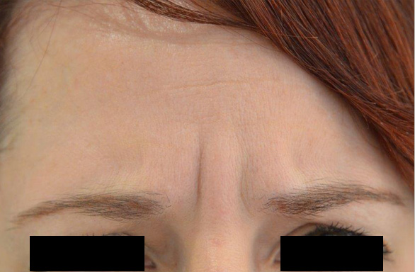 Before-This female patient received 51 units of BOTOX to her glabella and forehead. No more creases!