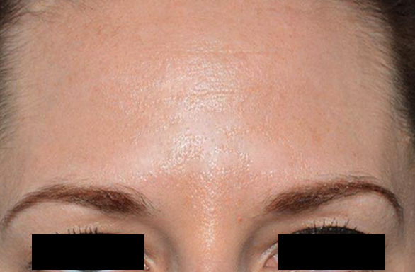 After-This female patient received 51 units of BOTOX to her glabella and forehead. No more creases!