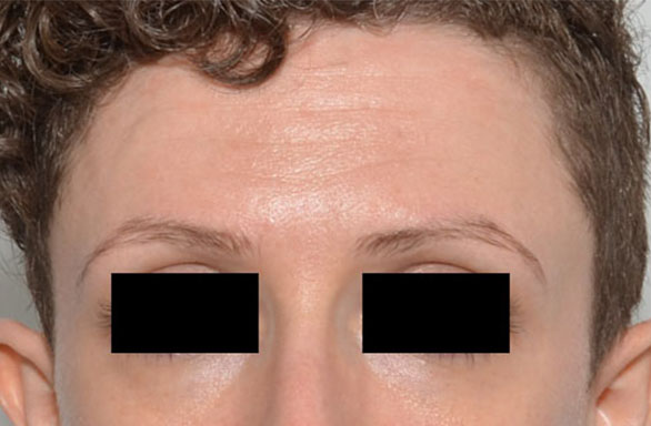 Before-This female patient received 51 units of BOTOX for her forehead. Notice how smooth her forehead looks after the treatment.