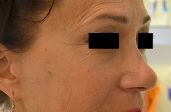 Before-This female patient received 54 units of BOTOX to treat forehead lines and and crows feet. Notice the dramatic improvement.