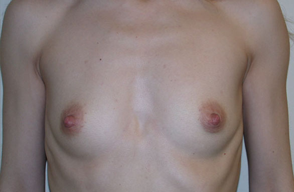 Before-36 year old female. Round Silicone Cohesive Gel, 290cc. Incision around nipple, Implant Pocket under breast and chest muscle.