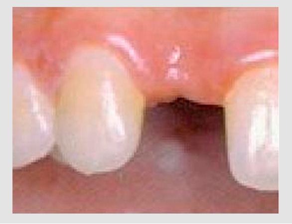 Before-Dental Implant