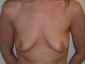 Before-Breast Implant